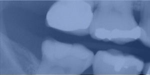 Intraoral x-ray